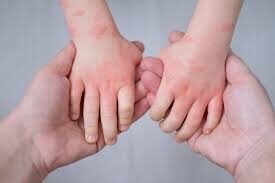 Piel Sensible: Afecciones Frecuentes en Bebés